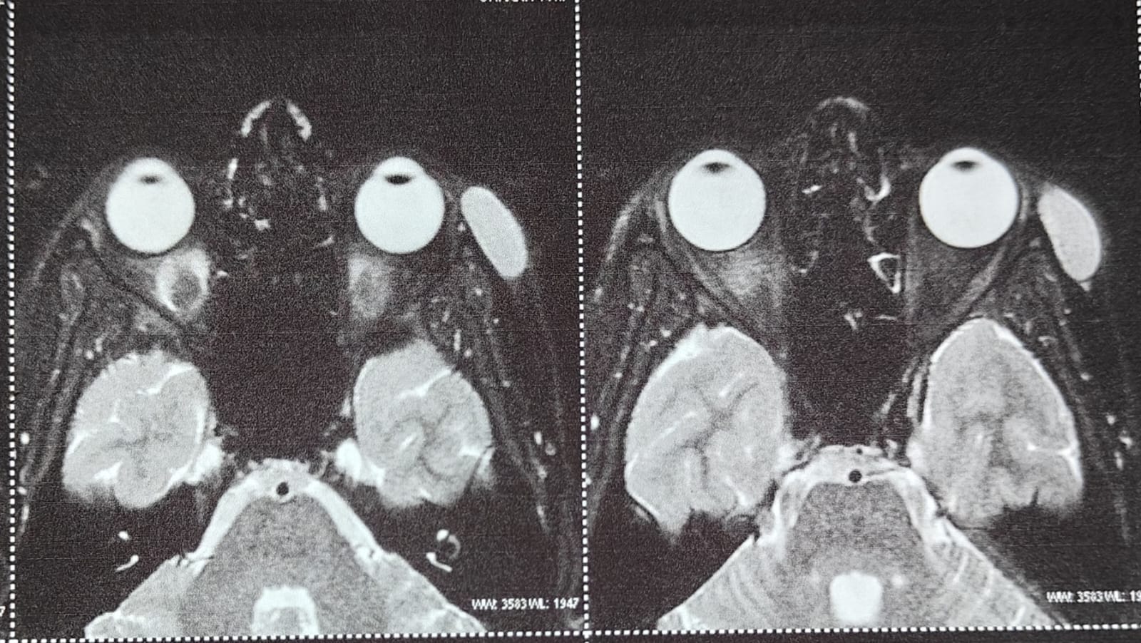 Periocular swelling post physical assault